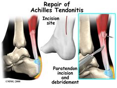 Physiotherapy in Regina, Physiotherapy for Achilles Tendon Problems