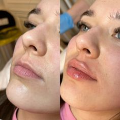 Ekkora eredménnyel jár, 1ml hialuron! 🫢💋  #teosyal #drgoodwin #doctor #beforeandafter #lips #lipfillersbeforeandafter #lipfiller #beautysalon #lips Narrow Mouth Lip Filler, Bow Shaped Lips Filler, Lip Filler Transformation, Before And After Lip Fillers Small Lips, Lip Flip With Filler, Lip Injections Inspiration, Lip Filler Downturned Lips, Chin And Lip Filler, Lip Filler Examples