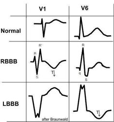 Lbbb Vs Rbbb, Paramedic Student, Cardiac Sonography, Cardiology Nursing, Medical Assistant Student, Paramedic School, Nurse Practitioner School, Nurse Study Notes, Medical Student Study