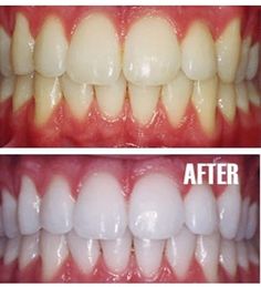 Put a tiny bit of toothpaste into a small cup, mix in one teaspoon baking soda plus one teaspoon of hydrogen peroxide, and half a teaspoon water. Thoroughly mix then brush your teeth for two minutes. Remember to do it once a week until you have reached the results you want. Once your teeth are good and white, limit yourself to using the whitening treatment once every month or two. Obličejové Masky, Tooth Whitening, Makeup Tip, Diy Kosmetik, Brush Your Teeth, Periodontal Disease, Oil Pulling, Beauty Remedies, Hydrogen Peroxide