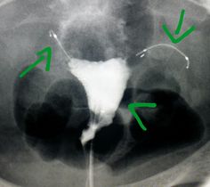 #Hysterosalpingogram: #endometrial #cavity (arrowhead) & #fallopian tube occlusion devises (arrows) to prevent #pregnancy. #radiologist #radiology Xray Tube Diagram, X Ray Positioning, Diagnostic Radiography, Fluoroscopy Radiology, Digital Radiography