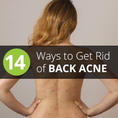 Keeva Organics Backne Remedies Diy, Backne Remedies, Get Rid Of Back Acne, Rid Of Back Acne, Acne Remedy, Back Acne Remedies, Chest Acne, Back Acne