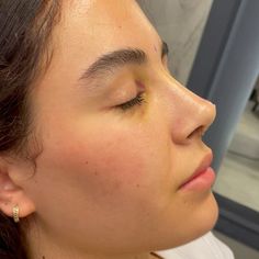 Button Nose Vs Straight Nose, Natural Looking Nose Job, Nose Job Inspiration Natural, Plastic Surgery Before And After, Bulbous Nose Rhinoplasty Before After, Nose Job Inspiration, Natural Nose Job, Nose Inspiration, Nose Goals