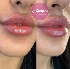 Big Lip Filler, Lip Fillers Shapes Natural, Get Fuller Lips Naturally, Fuller Lips Naturally, Cosmetic Tattooing