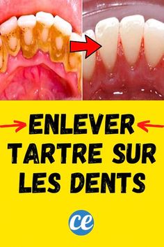 On sera tous d Dark Skin Around Neck, Toddler Tooth Decay, Tooth Decay Remedies, Dental Health Care, Skin Care Recipes