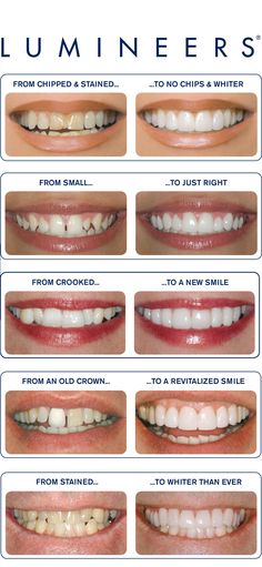 LUMINEERS Cases #MaldenDentalCenter #MaldenDentist #Lumineers #Veneers Teeth Makeover, Snap On Smile, Smile Dentist, Best Teeth Whitening Kit, Perfect Teeth, Dental Center, Best Teeth Whitening