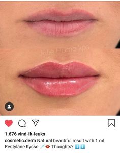 Restylane Kysse Lips Before And After, Julie Horne Lip Filler, Healed Lip Filler, Kysse Lips Filler Before And After, Lip Filler Shape Ideas Natural, Natural Lip Fillers 1ml, .5 Lip Filler, Half Syringe Lip Filler Before And After