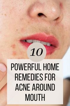 Discover effective home remedies for acne around the mouth. Learn how to treat and prevent breakouts naturally for clear, glowing skin. Acne Around Mouth, Remedies For Pimples, Remedies For Acne, Get Rid Of Acne, Rid Of Acne, Clear Glowing Skin