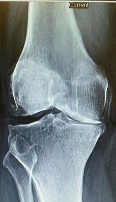 My Knee Guide provides comprehensive resources for knee replacement surgery preparation and recovery. Access us on internet or on our FREE iPhone app. Knee Replacement Surgery, Knee Replacement, Free Iphone, Iphone App, Surgery, Internet, Iphone