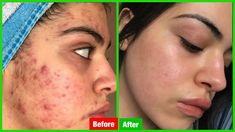 How to Remove Pimples Overnight | Acne Treatment - Best Home Remedy#howtoremovepimples #acnetreatment #pimples #acnemask #acne #postacne Remove Pimples Overnight, To Remove Pimples, Get Rid Of Pimples, Remove Pimples, Rid Of Pimples, Essential Oils For Pregnancy, Pimples Overnight, Improve Nutrition