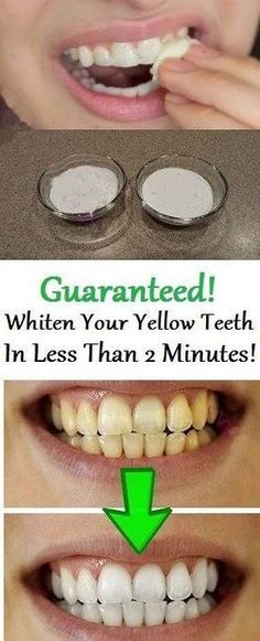 Yellow teeth are very embarrassing, and therefore, don’t want to smile and laugh.Luckily, you can have white teeth without spending your money on products that are filled with chemicals and don’t g… Teeth Whitening Methods, Whiten Teeth, Yellow Teeth, The Teeth, Benefits Of Coconut Oil, Natural Teeth Whitening, Natural Teeth, Teeth Care, White Teeth