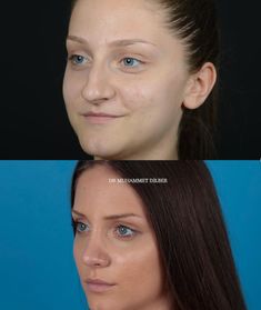 Face Symmetry Fillers, Natural Rhinoplasty, Natural Nose Job, Nostril Reduction, Chin Reduction