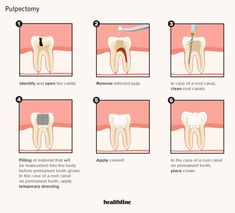 Pulpectomy is a procedure to save a severely damaged tooth; usually a baby tooth, and it can prevent problems with chewing, speech, and overcrowding that can occur when a baby tooth is lost too soon..
#oralhealthcaretips #healthteeth Dental Assistant Study, Dental Images, Dairy Free Breastfeeding, Skin Moles, How To Prevent Cavities, Migraine Headaches, Root Canal, Healthy Smile, Baby Teeth