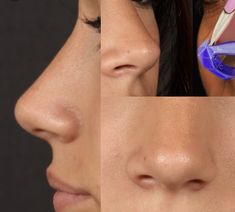 Nose Jobs, Nose Reshaping, Straight Nose