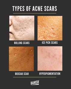 Acne Scar Remedies, Getting Rid Of Scars, Scar Remedies, Acne Scaring