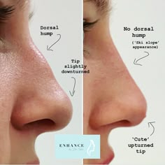 Ski Slope Nose, Hump Nose, Slope Nose, Nose Filler, Nonsurgical Nose Job, Drawing Nose