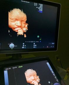 a computer screen with an image of a baby's head on it and another monitor showing the infant