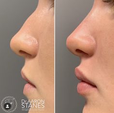 Nose Ideas, Nose Lift, Lips Inspiration, Facial Fillers