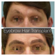 This gentleman had natural thinning of his right eyebrow as well as significant hair loss in his left eyebrow due to prior basal cell cancer that was reconstructed with a forehead skin flap. He is shown before and nine months after a single eyebrow hair transplant to reconstruct both eyebrows. Before And After Eyebrows, Hair Transplant Women, Basal Cell