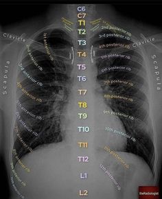 an x - ray shows the chest and lungs with words written in different languages on it