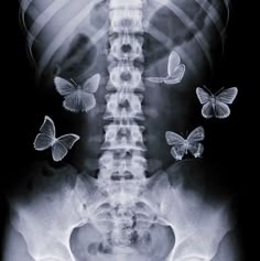 an x - ray shows butterflies flying around the neck