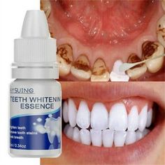 Containing Whitening Ingredient it could removes the stains resulted from smoking and drinking tea in a more effective way, and make your teeth white and glare Unique Active :could whiten the teeth in depth, prevents the teeth stains from forming again,and maintain the whitening effect for a long time Double-Effective Protective :While whitening the teeth,the could prevents new color pigment from attaching to your teeth, so as to ensure your Healthys and confident smile Keep your gingival more Healthys. Long-term use of this product shalls help to keep periodontal problems away Durable and pratical, not easy to break. Specifications: Color: As Picture Product Type: Teeth Whitening essences Function: Cleaning Teeth, removes Tooth Stains Usage: Teeth Whitening Gender: Unisex Occasion: Home Q Best Toothpaste White Teeth, Diy Teeth, Natural Teeth Whitening Diy, Teeth Stain Remover, Baking Soda Toothpaste, Best Teeth Whitening Kit, Teeth Whitening Homemade, Teeth Whitening Diy, Teeth Whitening Toothpaste