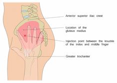 Dorsogluteal Injection Site, Menopur Injection Tips, Ventrogluteal Injection Site, Ventrogluteal Injection, Nursing Tools