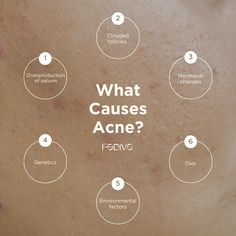 What Causes Acne, Identifying Triggers, Causes Of Acne, Esthetician Inspiration, Skincare Habits, Skin Facts, Skin Care Business, Clear Healthy Skin