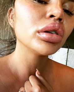 Chrissy Teigen Shares Photo of Swollen Lips from an Allergic Reaction: 'Not Filler Fail' Plastic Surgery Fails, Cheek Implants, Plastic Surgery Fail, Botox Before And After, Plastic Surgery Gone Wrong, Large Lips, Lip Sync Battle, Celebrity Plastic Surgery