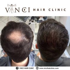 Hair Transplant Before And After, Micro Scalp Pigmentation, Hair Transplant Results, Hair Transplant Procedure, Androgenetic Alopecia, Crop Haircut, Bald Patches, Fue Hair Transplant, Hair Clinic