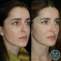 Jawline Contour, Chin Implant, Jaw Surgery