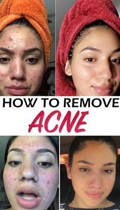 Acne Scar Removal Cream, Acne Scaring, Teenage Acne, Scar Removal Cream, Skin Moles, Acne Oil, Brown Spots On Face, Acne Scar Removal