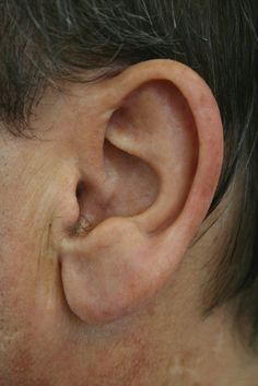 a close up of a person's ear with an uncut in the middle