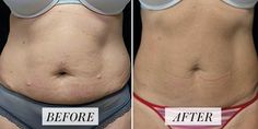 before and after photos of a tummy surgery procedure