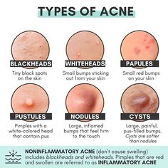 acne chart, acne types, acne, teen acne, acnes Skincare For Combination Skin, Different Types Of Acne, Haut Routine, Skin Facts, Acne Tips, Clear Healthy Skin, Types Of Acne