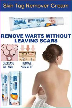 Wart Remover Cream, Instant Blemish Removal Gel, Extra Strength Skin tag Remover Cream , Natural Ingredients,Safe & Quickly Remove Skin Tag, Wart and Callus #ChineseNaturalRemedies #NaturalRemediesForGallbladderHealth Melanin Skin, Skin Moles, Losing 40 Pounds, Home Remedy For Cough, Skin Natural Remedies, Cold Sores Remedies