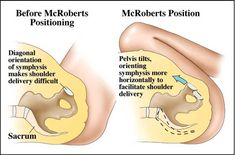 an image of two different positions of the same person's pedistrion