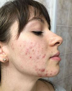 Bad Skin Pictures, Bad Acne Pictures, Normalize Acne, Strawberry Freckles