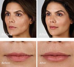 https://flic.kr/p/ZRbYJA | Volbella Lip Filler | Volbella Lip Filler Dr. John L. Burns, Jr., MD Board Certified Plastic Surgeon President, Dallas Plastic Surgery Institute Face Fillers, Aesthetic Dermatology, Lip Service, Hair Nails