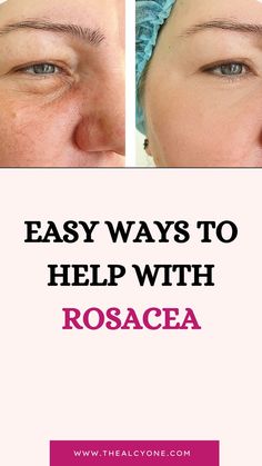 This is what you should do if you have rosacea Reduce Face Redness, Skin Care 30s Women, Redness On Face, Chin Hair Removal, Best Skincare Routine, The Best Skincare, Acne Solutions, Best Skincare, Effective Skin Care Products