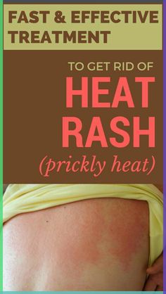 Heat rash is a hurting skin condition that frequently occurs in hot weather. Let’s seize a look at s Heat Rash Remedy, Home Remedies For Rashes, Prickly Heat Rash, Rashes Remedies, Surviving Summer, Road Rash, Prickly Heat, Home Remedies For Skin, Heat Rash