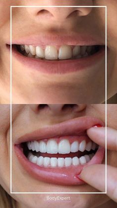 Illuminate your smile with these six speedy methods to whiten your teeth at home: 1. Baking Soda & Hydrogen Peroxide 2. Activated Charcoal Tooth Decay Remedies, Whiten Teeth, Dental Veneers, Smile Teeth, Dental Cosmetics