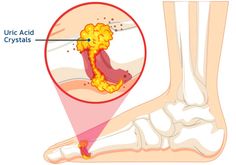 Natural Form, Nerve Pain