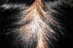 Hair loss types: Central centrifugal cicatricial alopecia overview Cross Sectional Study, Going Bald, Scar Tissue, Hair Regrowth, Medical Problems, African American Women, Hair Follicle, Grow Hair