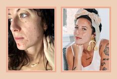 With And Without Makeup, Nontoxic Beauty, Natural Oils For Skin, Pimples Remedies, Acne Skincare, Natural Acne Remedies, Facial Skin Care Routine, Acne Remedies, Skin Cleanser Products