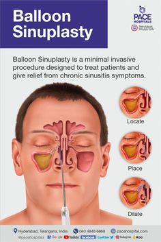 We are one of the best hospital for sinusitis treatment in Hyderabad. We are equipped with state-of-the-art facility and latest technology, offering comprehensive treatment for Sinus Infection, Chronic Sinusitis Treatment, and Sinus Surgery in Hyderabad. Sinusitis Symptoms, Remedies For Chest Congestion, Chronic Sinusitis, Uses For Vicks, Congestion Relief, Acne Overnight