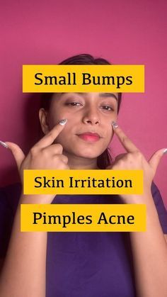 Irritated Skin, Acne, Beauty Hacks, Skin, Beauty