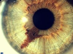 an extreme close up view of the iris of a person's eye with brown patches on it