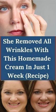 Wrinkles Remedies Face, Homemade Wrinkle Cream, Glow Skincare, Wrinkle Remedies, Wrinkle Free Skin, Erase Wrinkles, Skin Care Wrinkles, Hydrated Skin