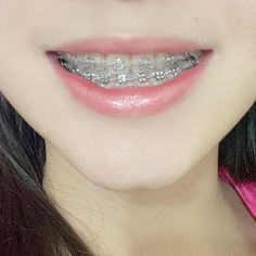 Braces Aesthetic Colors, Braces Aesthetic Girl, Aesthetic Braces, Braces Aesthetic, Braces Colors Ideas